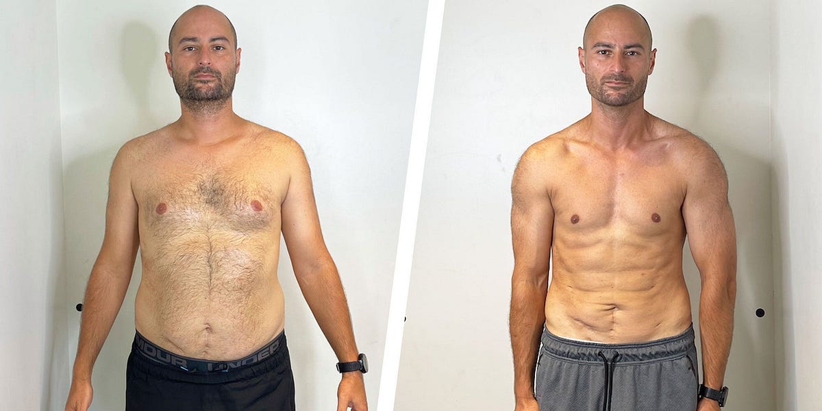 Synedica Retatrutide before and after weight loss result 3 (-20 kg · 100 days)
